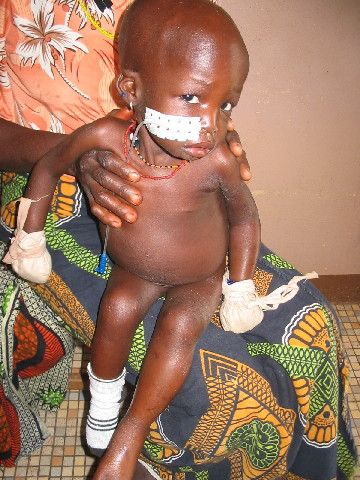 enfant malnutri