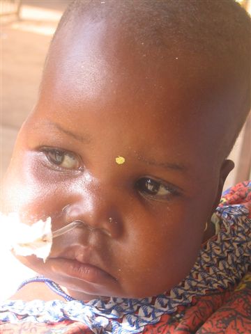 enfant malnutri
